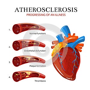 Atherosclerosis, blood clot formation. Vector medical illustration