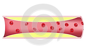 Atherosclerosis. Blood clot and Plaque formation.
