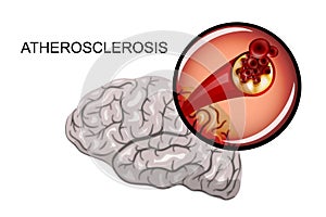 Atherosclerosis of brain vessels