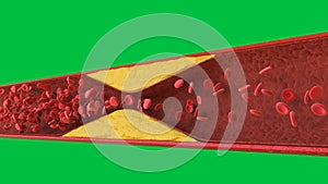 Atherosclerosis with cholesterol blood