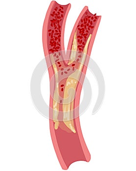 Atherosclerosis is a disease in which the inside of an artery narrows due to the build up of plaque.