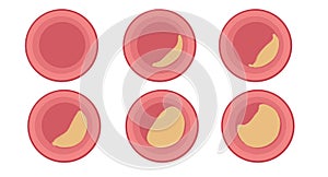 Atherosclerosis is a disease in which the inside of an artery narrows due to the build up of plaque.