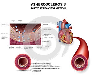 Atherosclerosis. Early stage