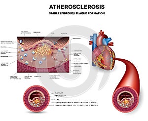 Atherosclerosis. Fibrous plaque formation