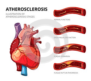 Atherosclerosis. Fibrous plaque formation. Vector