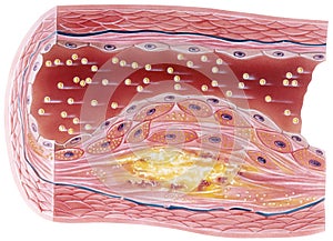 Atherosclerosis - Plaque