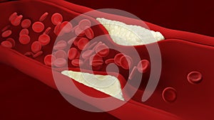 Atherosclerosis. Plaque builds up inside an artery. Blood cells.