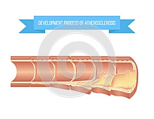 Atherosclerosis process on different stages from healthy vessel to fibroatheroma and complicated lesion