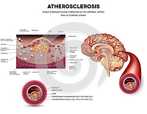 Atherosclerosis. Stable plaque formation