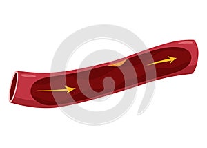 Atherosclerosis stage. Anatomy of heart attack. Arteriosclerotic vascular disease or ASVD. Atherosclerotic plaque in