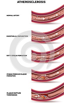 Atherosclerosis stages