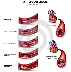 Atherosclerosis stages