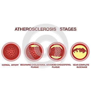 Atherosclerosis stages.The accumulation of cholesterol in the blood vessels. Atherosclerosis