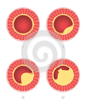 Atherosclerosis stages in artery