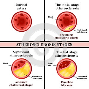 Atherosclerosis stages. Cholesterol plaques.