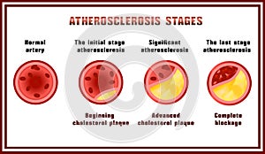 Atherosclerosis stages. Cholesterol plaques.