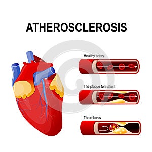 Atherosclerosis stages