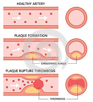 Atherosclerosis stages: healthy artery, plaque formation, and thrombosis in flat style isolated on white background. health care c