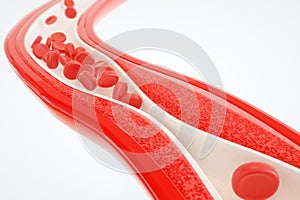 Angioplasty without stent placement- 3D rendering