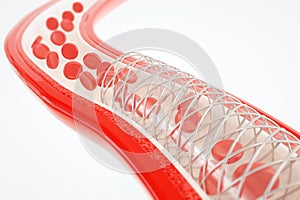 Angioplasty with stent placement- 3D rendering