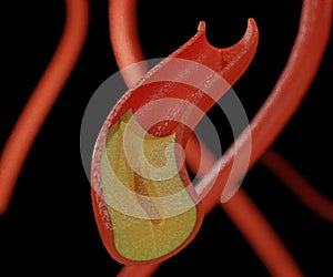 Atherosclerosis is thickening or hardening of the arteries caused by a buildup of plaque in the inner lining of an artery