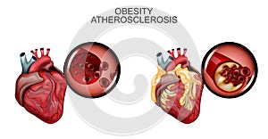 Atherosclerosis vessels of the heart