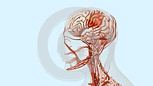 Atherosclerotic cardiovascular disease and stroke