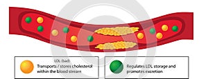 Atherosclerotic plaque in blood vessel