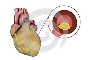 Atherosclerotic plaque in coronary blood vessel of obese heart, illustration