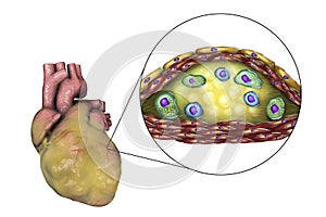 Atherosclerotic plaque in coronary blood vessel of obese heart, illustration