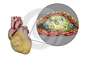 Atherosclerotic plaque in coronary blood vessel of obese heart, illustration