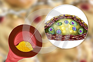 Atherosclerotic plaque in human artery