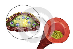 Atherosclerotic plaque in human artery