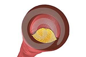 Atherosclerotic plaque in human artery