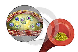 Atherosclerotic plaque in human artery