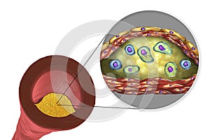 Atherosclerotic plaque in human artery photo