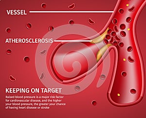 Atherosclerotic Vessels Medical Disease Banner