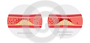 Atherotrombosis in vessels