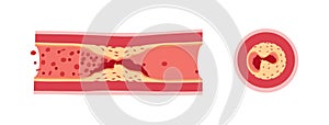 Atherotrombosis in vessels