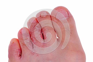 Athlete's foot fungus