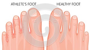 Athlete s foot and healthy foot top view photo