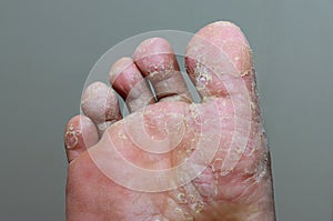 Athlete`s foot - tinea pedis, fungal infection