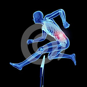 An athleteÂ´s painful back