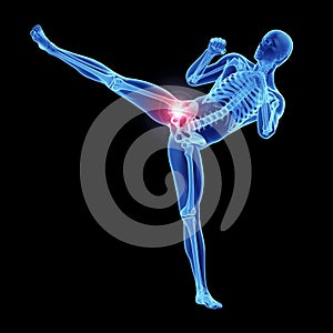 An athleteÂ´s painful hip joint
