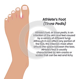 Athlete\'s Foot Tinea Pedis vector illustration vector infographic photo