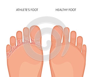 Athletes foot or tinea pedis soles of the feet