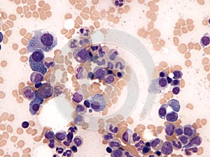 Atipycal plasma cell in bone marrow.