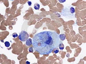 Atipycal plasma cell in bone marrow, POEMS syndrome.