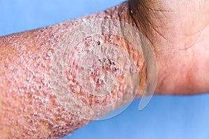 Atopic dermatitis AD, also known as atopic eczema, is a type of inflammation of the skin dermatitis.