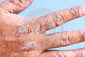 Atopic dermatitis AD, also known as atopic eczema, is a type of inflammation of the skin dermatitis.